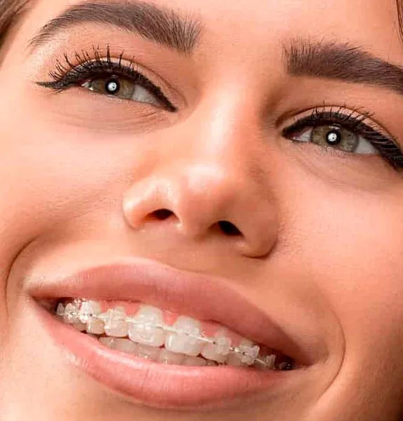 Sorriso com bráquetes ortodônticos estéticos