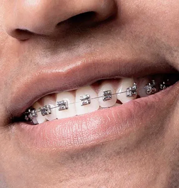 Close-up of metal self-ligating orthodontic braces