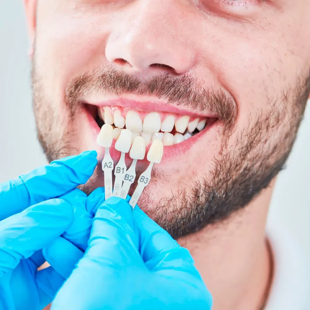 Selecting dental shades using a shade guide