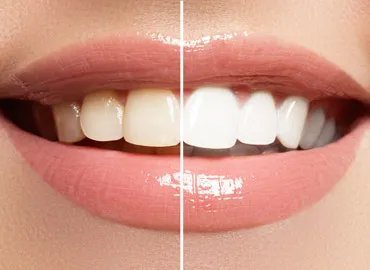 Comparação visual de um sorriso antes e depois do tratamento