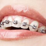 Invisalign: Quem pode usar?